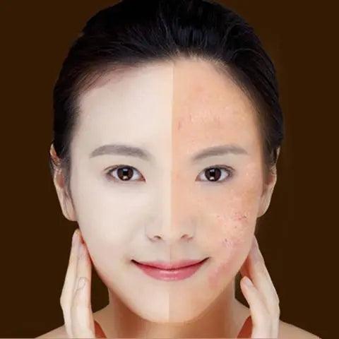 Clear Glow Blue Light Therapy Acne Laser Pen - Glowup