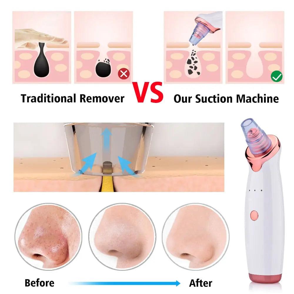 Clear Pore Electric Black head Remover - Glowup